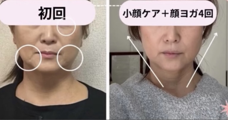 初回と小顔ケア＋顔ヨガ4回後のフェイスラインの変化