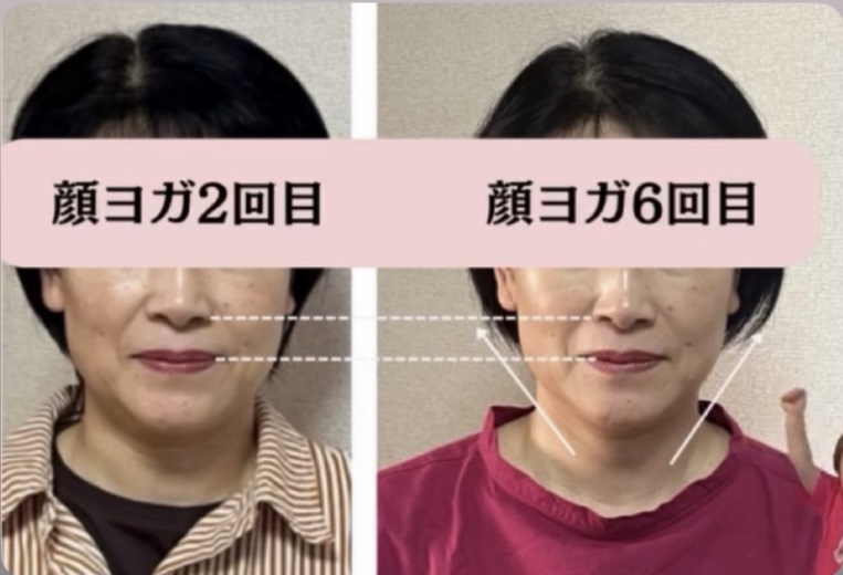 顔ヨガ2回目と6回目のフェイスラインの変化